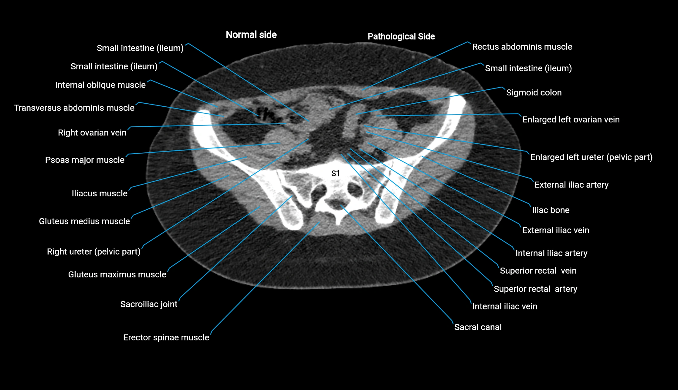 CT KUB axial cross sectional anatomy  radiology image -img-00201-00119.webp